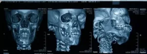 Компьютерная томография лицевого скелета: как проходит, когда нужна